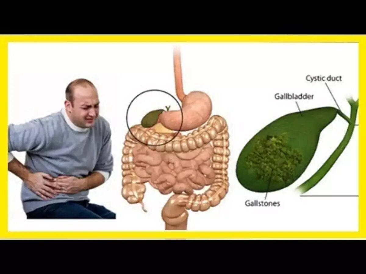 Желчекаменная болезнь холелитиаз. Желудочный пузырь камни. Конкременты желчного пузыря что это такое. Приступы желчного пузыря при камнях