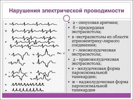 Нижняя стенка желудочка нарушение проводимости