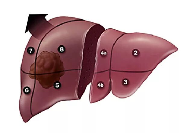 Гемангиома печени Liver resection. Гемангиома печени (Liver Hemangioma). Очаговые гемангиомы печени