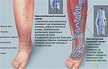 Недостаточность венозного клапана