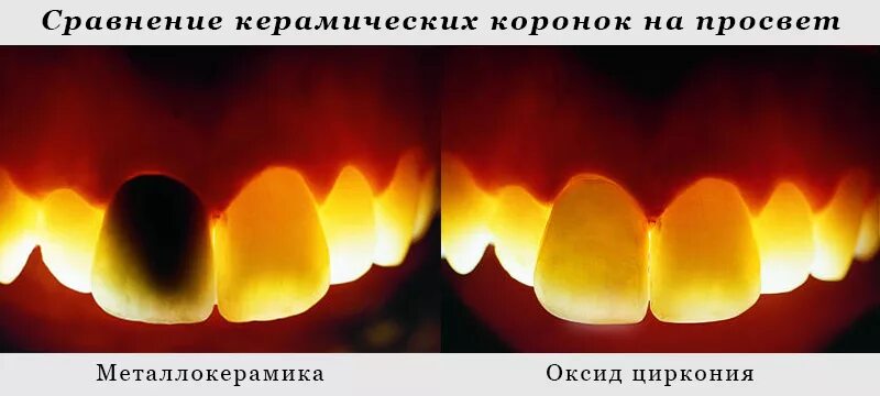 металлокерамическая коронка и диоксид циркония. чем металлокерамика отличается от циркониевой. чем металлокерамика отличается от циркониевой.