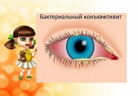 Профилактика конъюнктивита