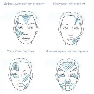Схема мезотерапии