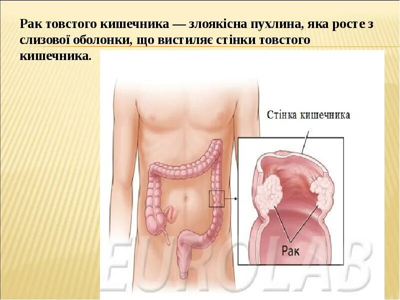 Как выглядит живот при раке кишечника 7 ранних предупреждающих признаков рака толстой кишки. Большинство людей упускаю