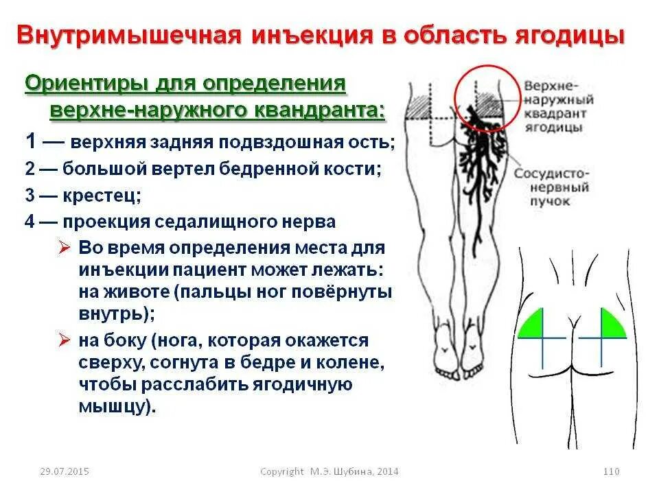 Сильно болят ягодицы. Схема введения внутримышечных уколов. Схема введения внутримышечной инъекции. Схема укола внутримышечно в ягодицу. Место постановки укола в ягодицу.