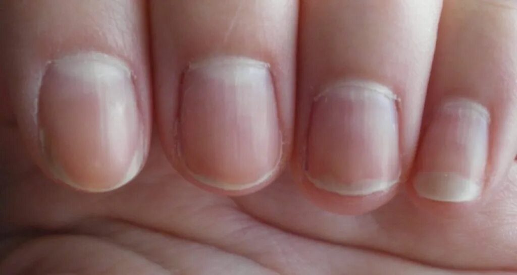 Почему ногти синеют причина. Продольные борозды на ногтях.