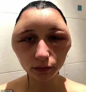 Багровое лицо