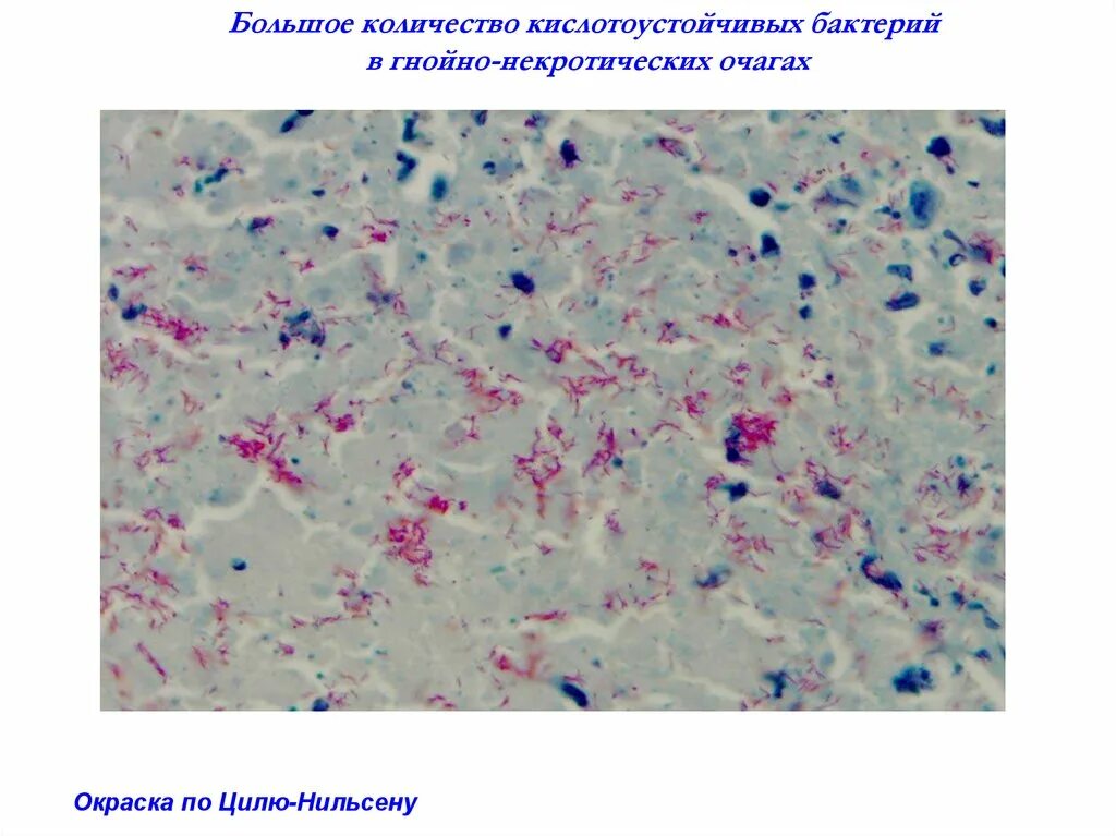 Микроскопия по Цилю Нильсену туберкулез. Циль Нильсен туберкулез. Окраска по Цилю Нильсену гистология. Микобактерии туберкулеза в мокроте окраска по Цилю Нильсену.