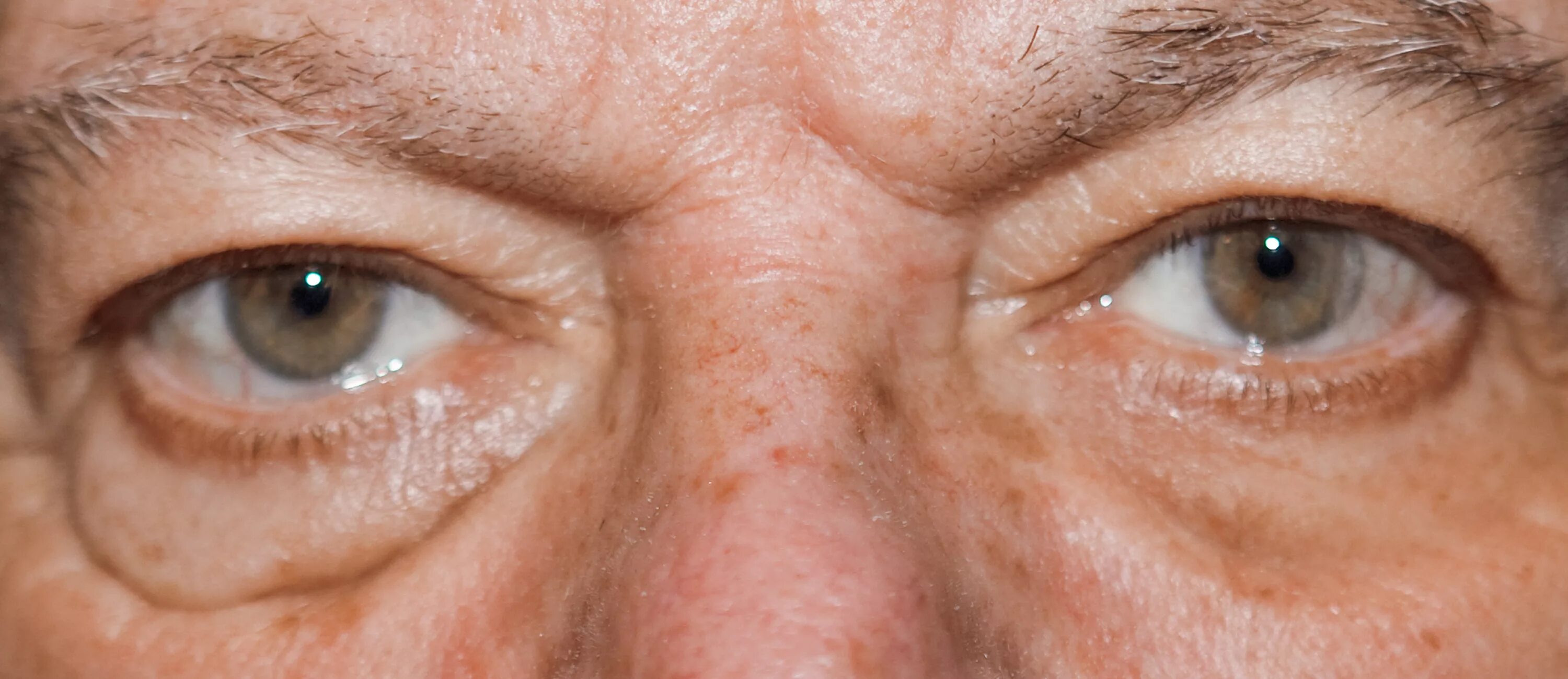 Водянистый отек под глазом. Лечение мешков под глазами у мужчин