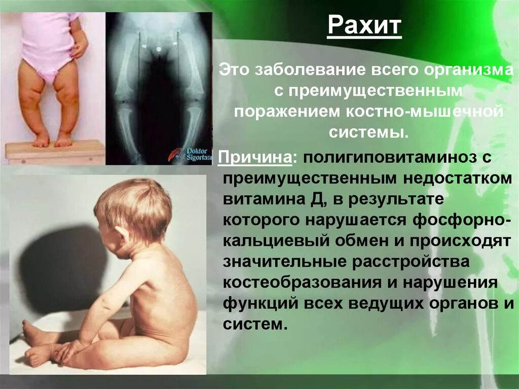 Разит купить. Хондродистрофия, рахит. Дети с заболеванием рахит.