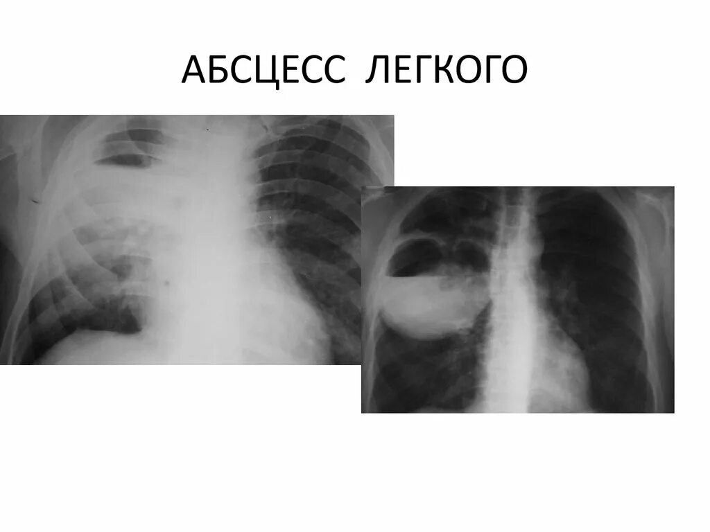 После абсцесса легкого. Недренирующийся абсцесс легкого. Нагноительные заболевания легких. Абсцесс легких..