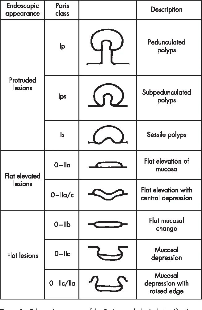 Тип 0 is. Классификация полипов эндоскопия. Парижская классификация эндоскопия. Классификация полипов 0-1s.