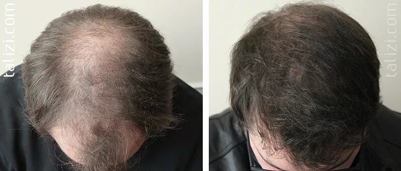 Андрогенетическая алопеция. Залысины от выпадения волос. Облысение у женщин до и после. Препарат для восстановления волос облысения. Андрогенная алопеция миноксидил.