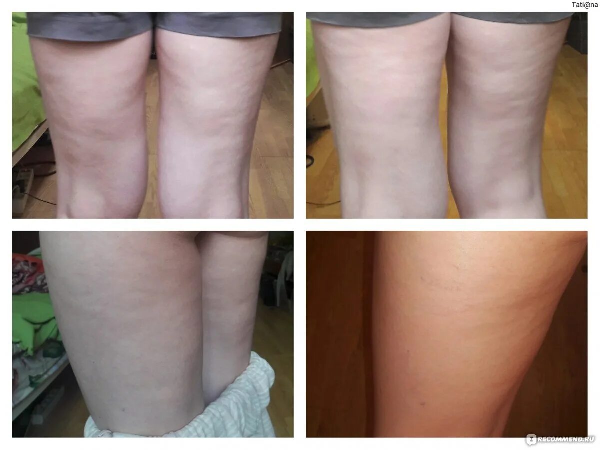 Медовое обёртывание от целлюлита. Обертывания от целлюлита до и после. Обертывание для похудения отзывы. Обертывания для похудения боков. Обертывание для похудения отзывы.