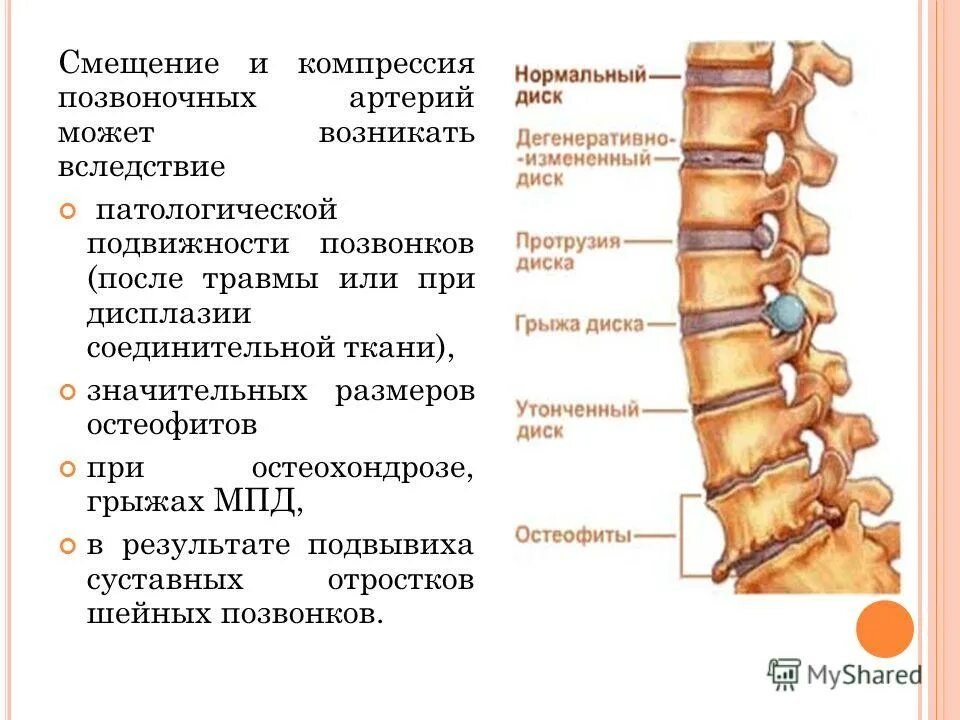 Остеофиты что это такое и как лечить