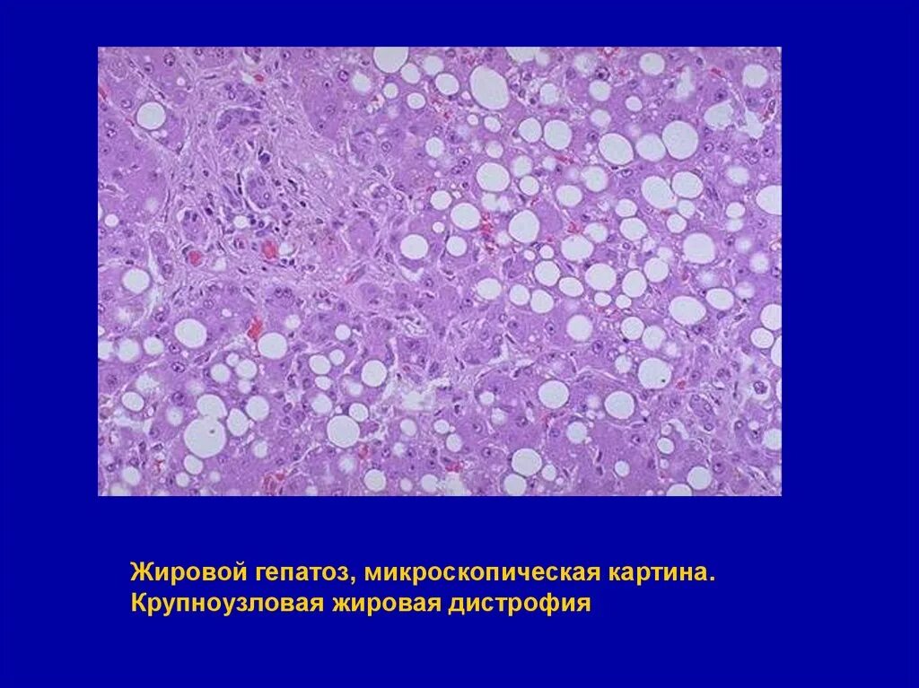 Жировой гепатоз гистология. Жировой гепатоз гистоло. Жировой гепатоз микроскопически. Жировая дистрофия печени. Лечение жирового гепатоза в домашних условиях