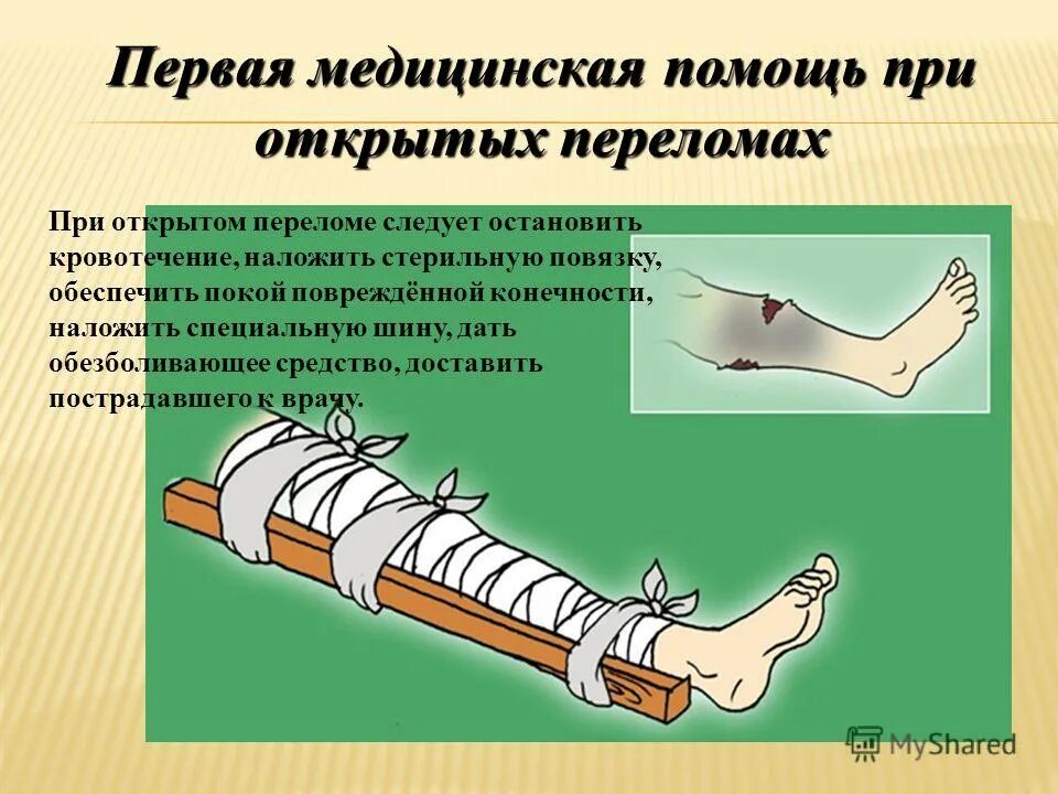 Оказание медицинской помощи при открытом переломе. Оказание первой медпомощи при открытом переломе. пмп при открытом переломе. первая помощь при открытом переломе с артериальным кровотечением. 6. алгоритм оказания первой помощи при открытом переломе?.