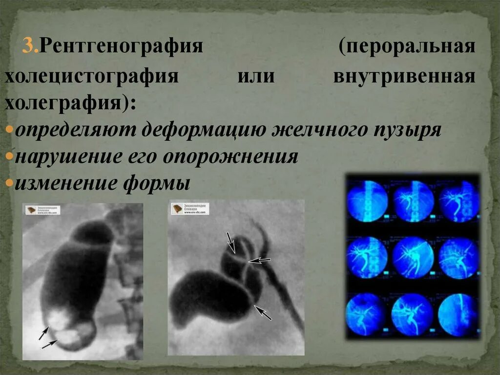 Пероральная холецистография. Внутривенная холецистография. Холесцинтиграфия. Холецистография рентгенологическое исследование.