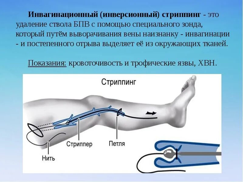 Удалить большую подкожную вену. Удалить большую подкожную вену