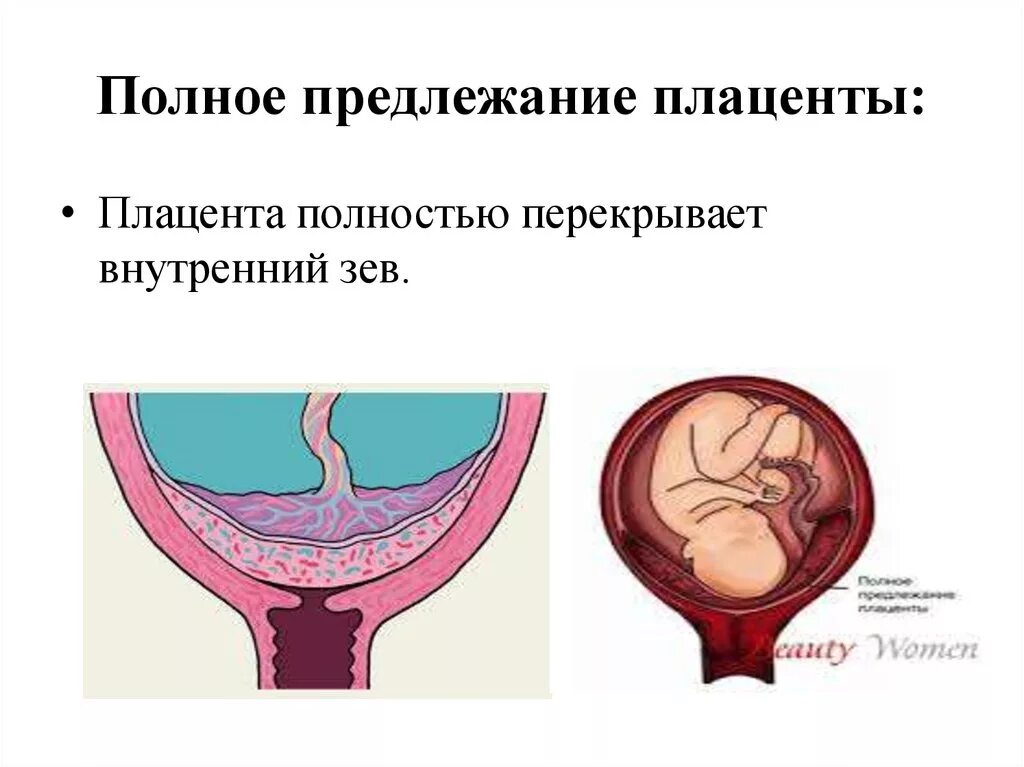 Плацента перекрывает внутренний зев 13 недель беременности. Предлежание плаценты внутренний зев. Предлежание плаценты с врастанием. Центральное предлежание плаценты УЗИ. Зев закрыт при беременности