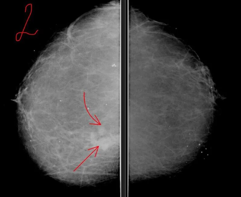 очаговая асимметрия левой молочной. опухоль молочной железы. очаговая асимметрия левой молочной. очаговая асимметрия левой молочной. маммография очаговая асимметрия.