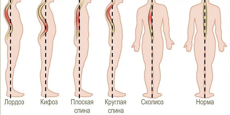 Усиленный лордоз. Лордоз поясничный 2 степени. Сколиоз кифоз кифосколиоз. Сглажен лордоз в поясничном отделе позвоночника. Лордоз кифоз сколиоз.