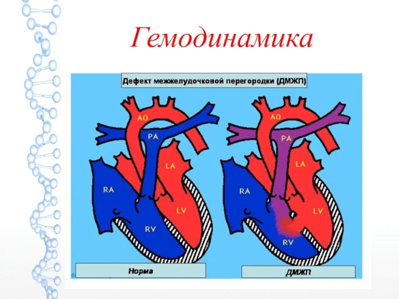 Дефект межжелудочковой перегородки гемодинамика схема. ДМЖП гемодинамика. Гемодинамика при ДМЖП схема. Дефект межжелудочковой перегородки гемодинамика. Гемодинамика у детей