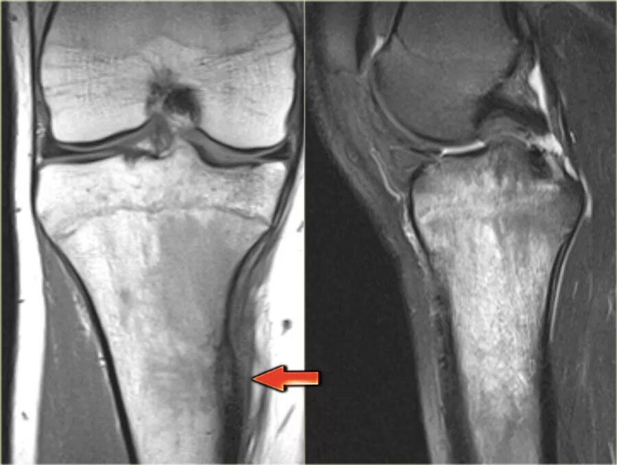 Отек медиального мыщелка. Остеоид остеома надколенника. Остеоидная остеома мрт. Остеома большеберцовой кости на кт.