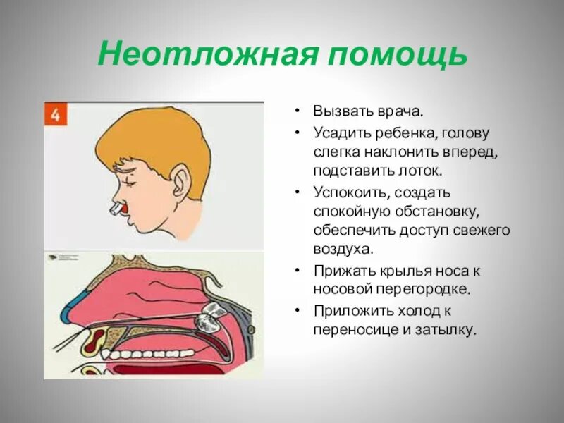 Положение головы при носовом кровотечении. Прижать Крылья носа к перегородке. Носовое кровотечение у детей неотложка. Неотложная помощь при носовом кровотечении у детей алгоритм.