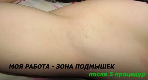 Электроэпиляция ростов на дону