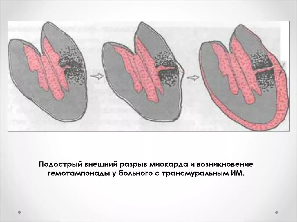 Разрыв сердца при инфаркте миокарда. Осложнение инфаркта миокарда разрыв миокарда. Внешние и внутренние разрывы миокарда. Наружный разрыв сердца.