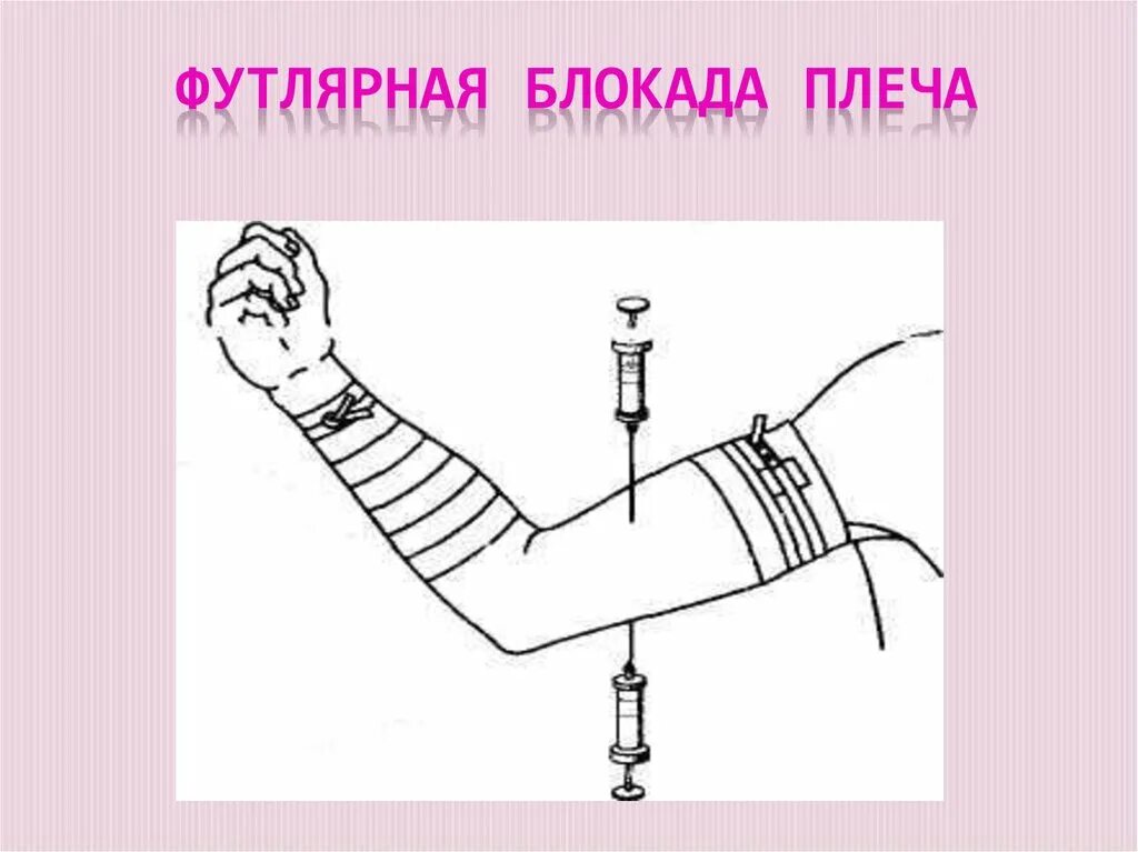 Футлярная блокада. Техника футлярной анестезии бедра. Новокаиновые блокады в хирургии. Футлярная новокаиновая блокада плеча. Футлярная блокада.
