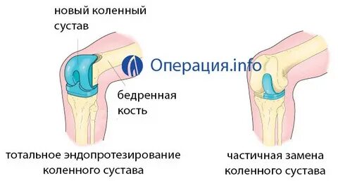 Болит коленный сустав после эндопротезирования
