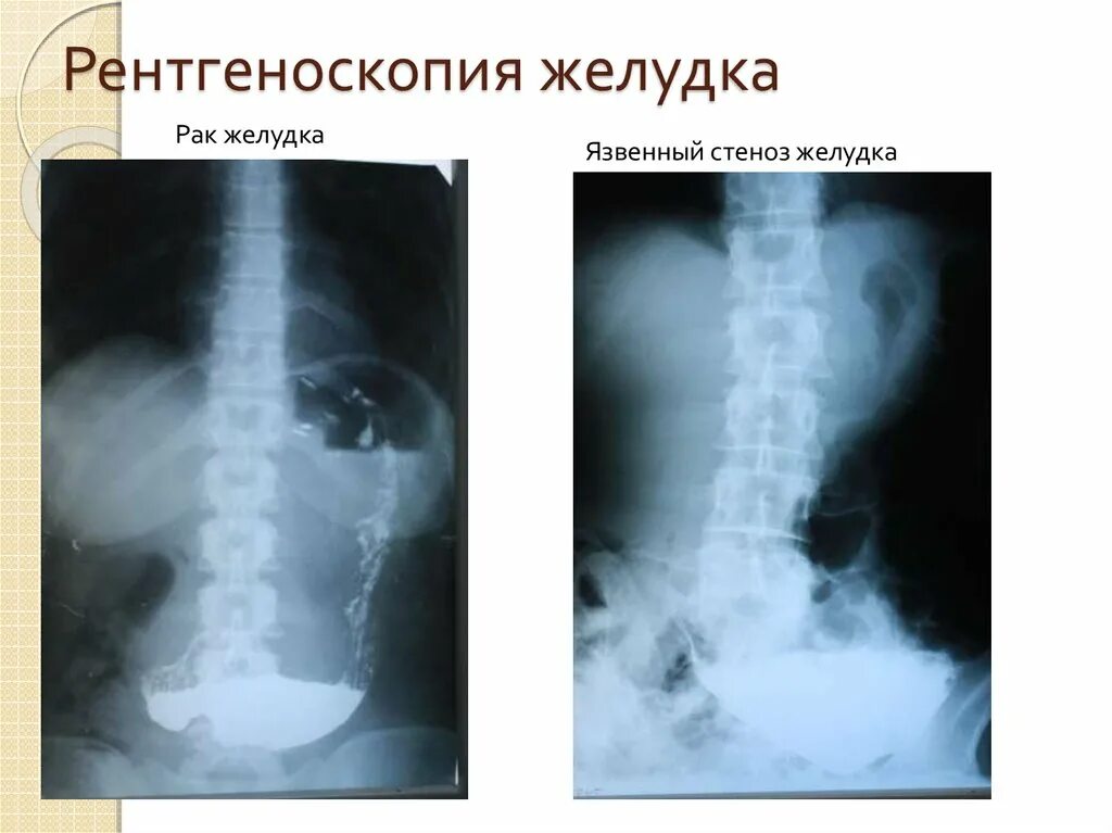 Рентгеноскопия пищевода подготовка