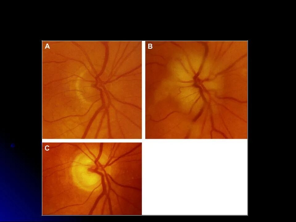 Ишемическая нейропатия зрительного нерва. Задняя ишемическая нейропатия зрительного нерва. Ишемическая нейрооптикопатия зрительного нерва. Передняя ишемическая оптическая нейропатия. Нейропатия зрительных