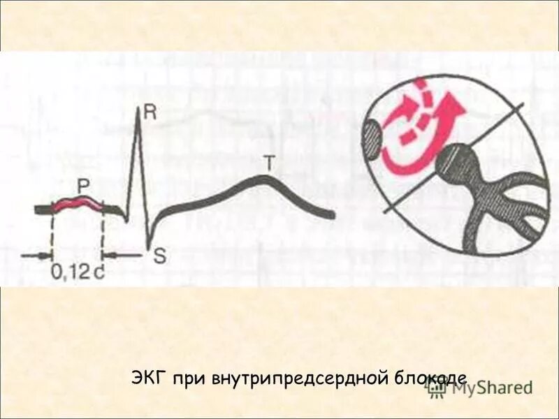 Что значит внутрипредсердная внутрипредсердная блокада. Внутрипредсердная блокада на ЭКГ. Межпредсердная блокада 3 степени ЭКГ. Признаки внутрипредсердной блокады на ЭКГ. ЭКГ при внутрипредсердной блокаде.