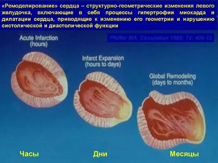 Левый желудочек изменения