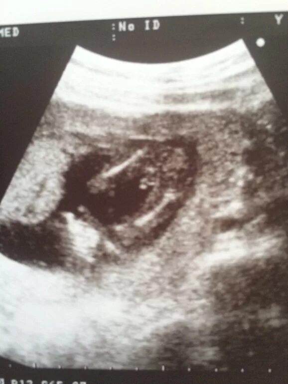 Снимок УЗИ 16 недель беременности мальчик. УЗИ 13-14 недель беременности мальчик. УЗИ мальчика и девочки на 15 неделе беременности. УЗИ мальчика 15-16 недель беременности. 17 недель мальчик