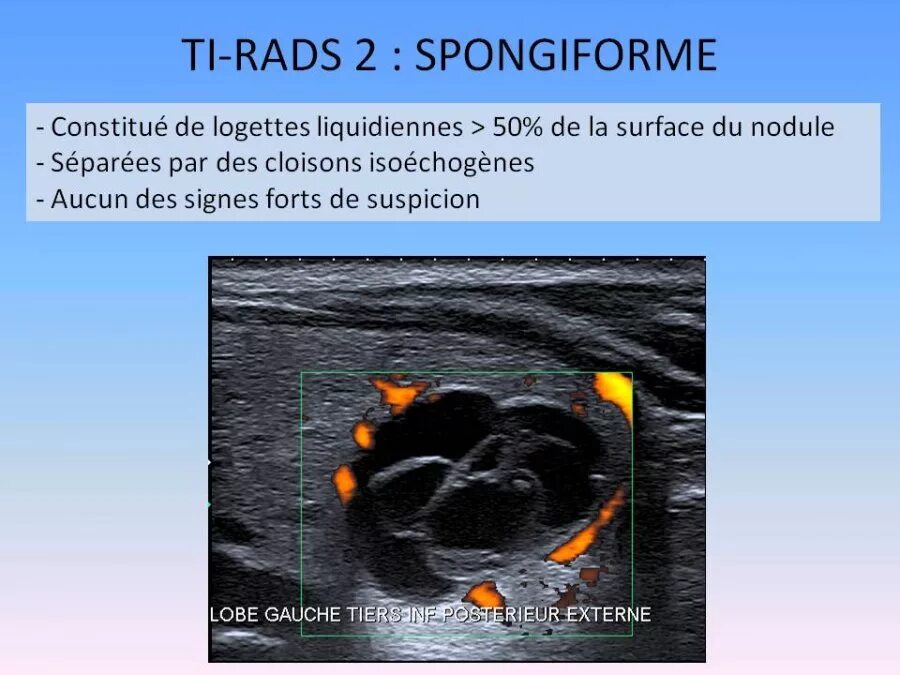 Eu tirads. Ti rads. Ti rads 2. Шкала eu Tirads. Категории Tirads.