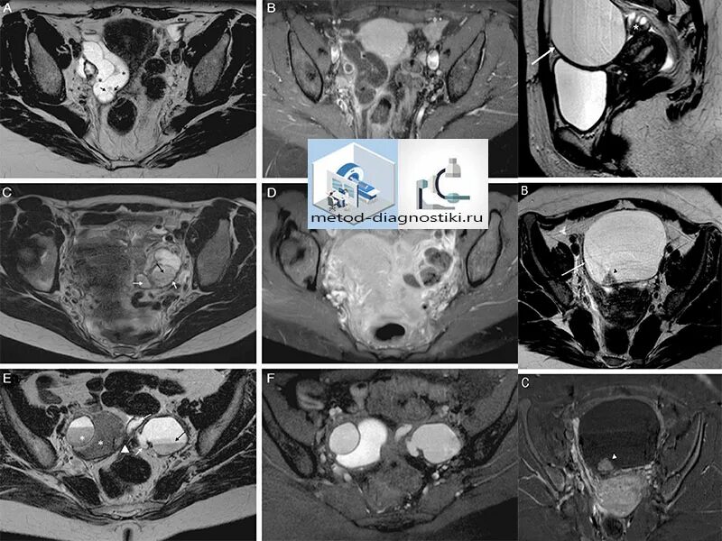 Магнитно-резонансная томография поликистоз яичников. Фиброматоз яичников мрт. Рак яичника мрт