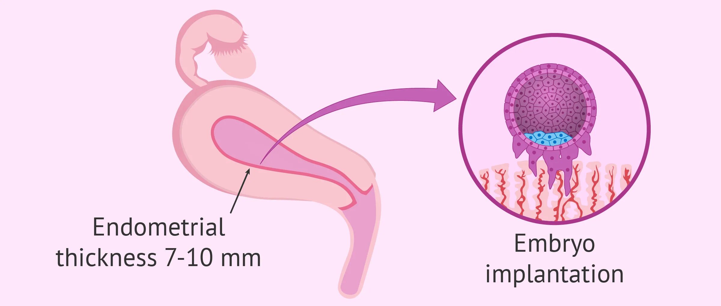 Имплантация эмбриона симптомы. Десквамация эндометрия. Трехслойный эндометрий. Эндометриоз и бесплодие. Имплантация в эндометрий.