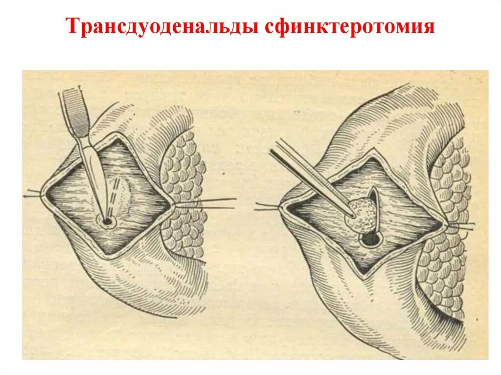 Анальная трещина. Подслизистая боковая сфинктеротомия. Боковая внутренняя сфинктеротомия. Боковая подкожная сфинктеротомия. Трансдуоденальная папиллосфинктеропластика.