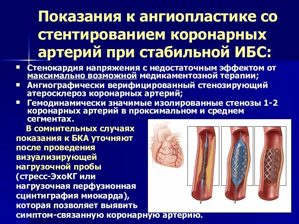 Терапия после стентирования. Аортокоронарное стентирование сосудов сердца. баллонная ангиопластика и стентирование артерий сердца. этапы стентирования коронарных артерий. стентирование коронарных артерий показания.