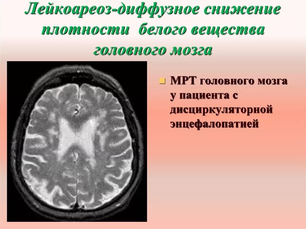 Диффузное поражение мозга. Перивентрикулярный лейкоареоз головного мозга мрт. Перивентрикулярный лейкоареоз головного мозга на кт. Кт признаки лейкоареоза головного мозга. Зоны лейкоареоза в головном мозге на кт.