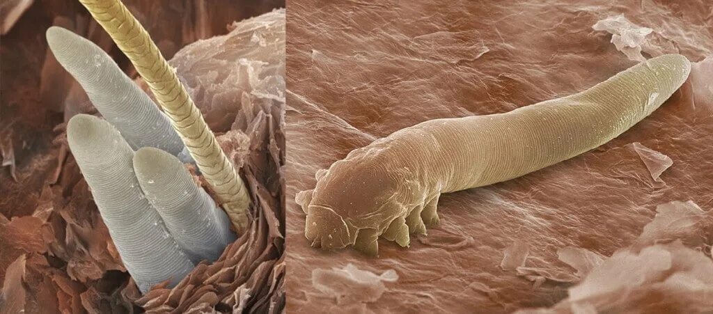 Демодекс фолликулорум. Железница угревая Demodex folliculorum. Подкожных клещей демодекс