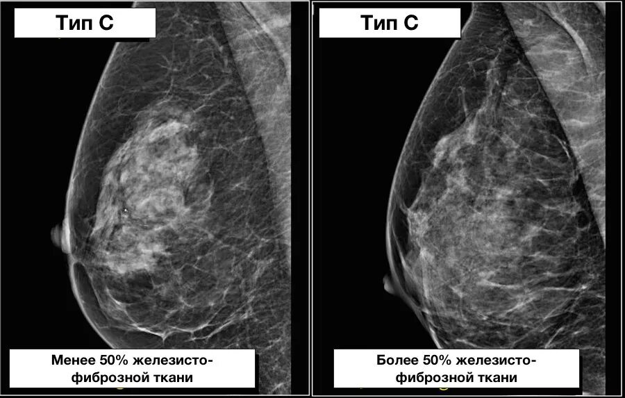 Что означает фиброзное изменение. Фиброзно-кистозная мастопатия маммография. Фиброзно-кистозная мастопатия на УЗИ. Кистозная мастопатия маммография. Фиброзная мастопатия молочной железы на УЗИ.