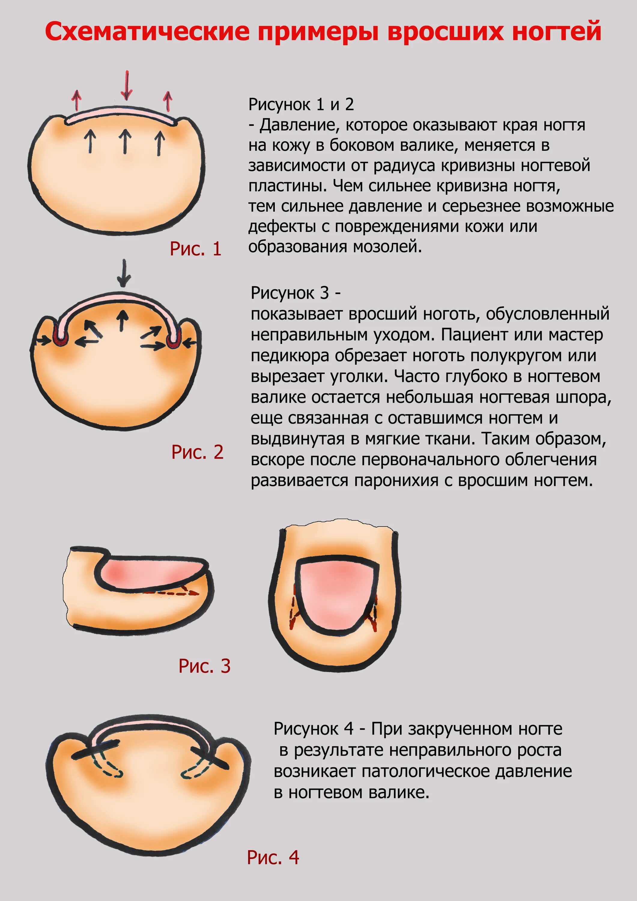 Обработка вросшего ногтя схема. Вырастает ноготь что делать