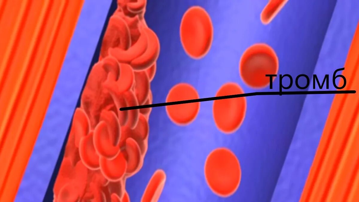 Закупорка тромбом кровеносного сосуда. Чем отличается тромб
