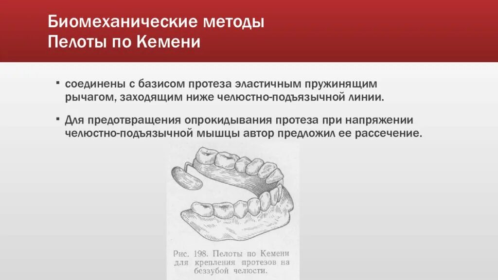 Линия базиса. Биомеханический метод фиксации протезов. Пелоты Кемени. Методам фиксации полных съёмных протезов. Методы фиксации экзопротезов.