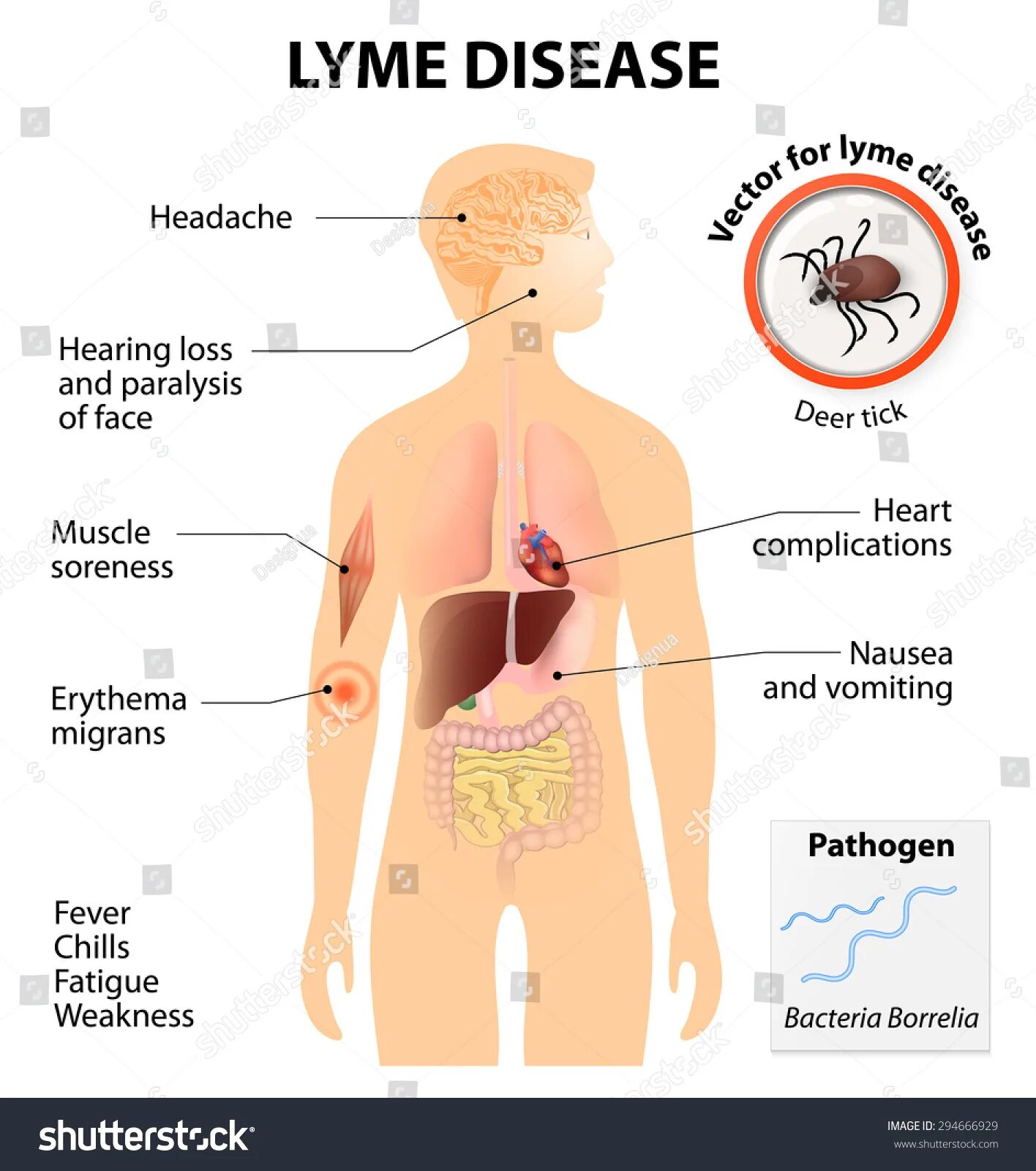 Heart failure. Disease symptoms. Большое сердце болезнь лечение. Пациент инфографика. Болезнь кастлемана клинические рекомендации.
